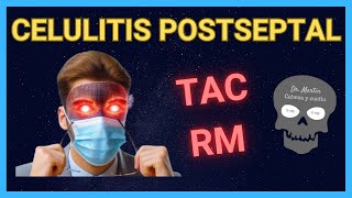 CELULITIS POSTSEPTAL Signos Radiológicos 👀 [upl. by Salome233]