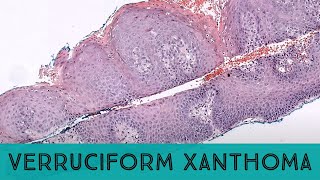 Verruciform xanthoma looks like a quotwart on firequot with foamy cells in dermis pathology dermpath [upl. by Deborath137]