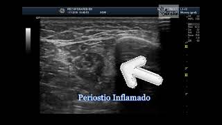 periostitis tibial medial [upl. by Amer322]