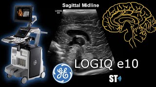 GE Logiq e10 Neurosonography demo and protocol [upl. by Naryb]