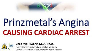 Prinzmetals Angina causing Cardiac Arrest [upl. by Akirdnuhs797]