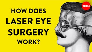 How does laser eye surgery work  Dan Reinstein [upl. by Barty]