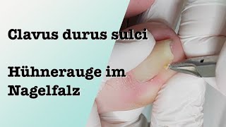 Clavus durus sulci Hühnerauge im Nagelfalz entfernen podologinandrea [upl. by Enutrof]