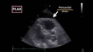 Pericardial Effusion with Doppler Echocardiographic criteria for Tamponade [upl. by Auhso]