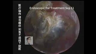 Ear wax removal Oily cerumen and fungal cleaning 🧹 20230911 [upl. by Plafker]