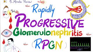 Rapidly Progressive Glomerulonephritis RPGN  Cresenteric  Nephritic Syndrome Subtypes [upl. by Rettig644]