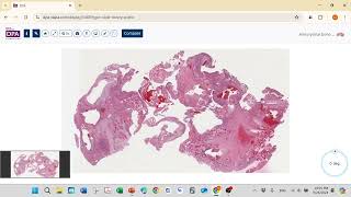 2024 09 26 Aneurysmal Bone Cyst [upl. by Atipul]