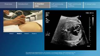 Key screening views of the fetal heart  Part 3  4chamber view [upl. by Nishom]