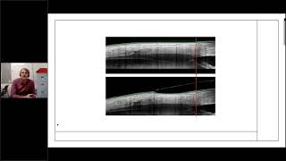 Annual Scleral Lens Society Research Update [upl. by Carrnan156]