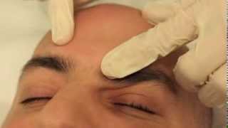 Sebaceous Hyperplasia removal [upl. by Nylednarb289]