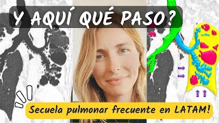 ¿Qué pasó aquí 😮 ¡Secuela pulmonar frecuente en LATAM [upl. by Ivets810]