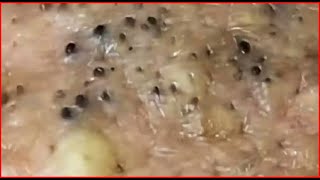 Pimple Popping Blackheads On Skin 😲😲 [upl. by Clere803]