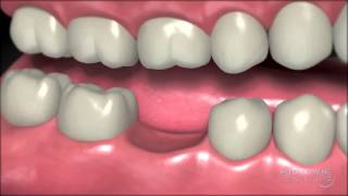 Dental Implants  Why You Should Have One [upl. by Silevi]