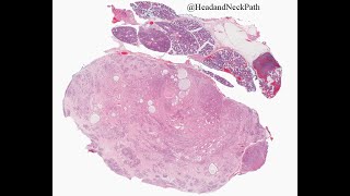 2020 12 CSP Lester Thompson Salivary Gland Pitfall Alert [upl. by Leiser]