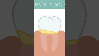 How to Remove Plaque From Teeth  dentalcare plaqueremoval shorts [upl. by Combs596]