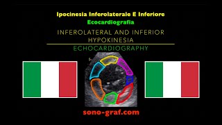 Ecocardiografia  Ipocinesia Inferolaterale E Inferiore [upl. by Daisey425]