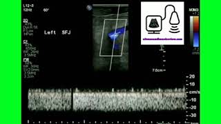 Monophasic Doppler Waveform [upl. by Schreiber342]