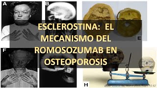 Esclerostina Cómo funciona qué papel tiene en el hueso en osteoporosis y en el romosozumab [upl. by Alih]