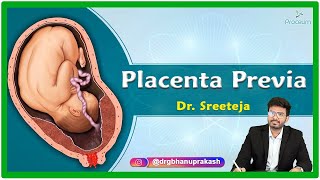 Placenta Previa Etiology Pathophysiology Clinical presentation Diagnosis and Treatment [upl. by Stasny]