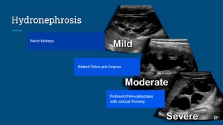 Hydronephrosis Ultrasound [upl. by Lovett121]