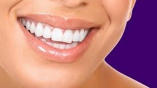 184 Teeth whitening Procedure Carbamide Peroxide [upl. by Philomena]