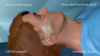 3D MACS and Neck Lift [upl. by Robina5]