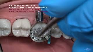 Class II amalgam restoration – Mandibular molar 36  Arabic عربي [upl. by Etiuqal]