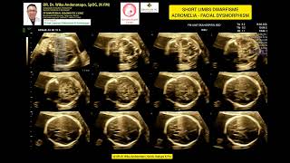 Shortlimbs Dwarfisme  Acromelia  Facial Dysmorphism [upl. by Irami]