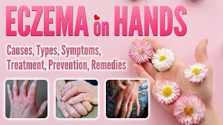 Eczema on Hands Causes Types Pictures Symptoms Treatment Natural Remedy  Hand Dermatitis [upl. by Marrilee475]