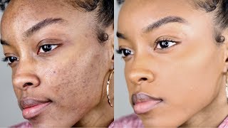 How to cover acnedark spots WITHOUT a lot of makeup  Slim Reshae [upl. by Purdy607]