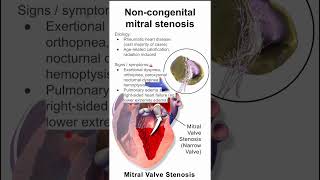 Mitral stenosis in adults [upl. by Maffei729]