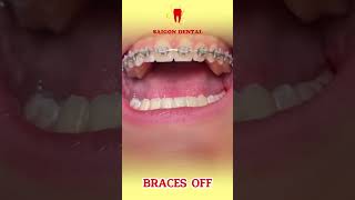 Removing Braces at Saigon Dental Center  Brace Off  Saigon Dental Center dentist dental [upl. by Ami]