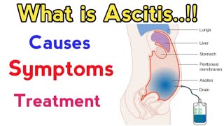 causes of ascites fluid in abdomen  treatment of ascites due to liver cirrhosis  ascites fluid [upl. by Niwrek]