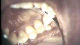 Periodontal Examination Part II Charting [upl. by Irak]