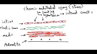 Systemic pathology 10  CVS  atherosclerosis  DRSAMEH GHAZY [upl. by Harifaz785]