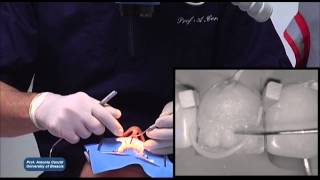 IPS Empress Direct StepbyStep with Prof Antonio Cerutti [upl. by Elrae638]