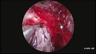 Intracranial Esthesioneuroblastoma  three layer reconstruction 2 fascia lata and pericranial flap [upl. by Tybald]