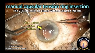 CataractCoach 1266 manual CTR capsular tension ring insertion [upl. by Acilef]