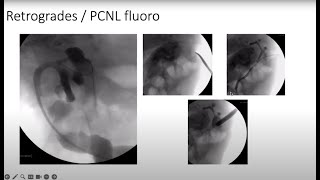 Case Report Complex Stone Disease With a Complex Anatomy [upl. by Heather]