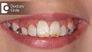 How do you treat Dental Fluorosis  Dr Aniruddha KB [upl. by Atihcnoc]