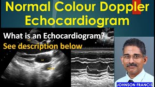 Normal Color Doppler Echocardiogram [upl. by Pegma]