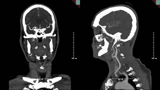 Endovascular mgmt of basilar artery occlusion secondary to fusiform aneurysm w intraluminal thrombus [upl. by Nibor]