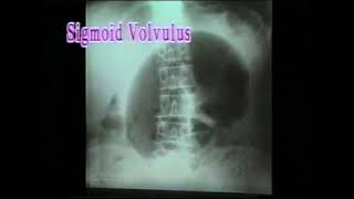 534 Sigmoid Volvulus  Abdomen Xrays  Dr Vaidya [upl. by Eilime]