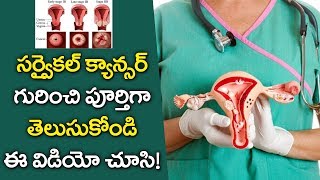 What is Cervical Cancer   Cervical Cancer Causes Diagnosis and Symptoms  Y5 Tv [upl. by Defant]