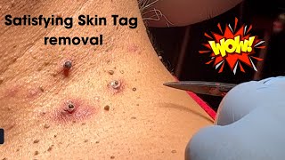 Amazing Satisfying Skin Tag Removal [upl. by Leontyne2]