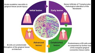 Periodontal Pathogenesis  Part 1 [upl. by Malia]