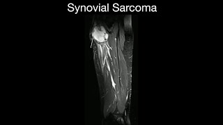 Synovial Sarcoma [upl. by Sinclare]