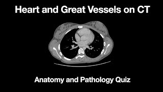 The Heart and Great Vessels Anatomy and Pathology Quiz [upl. by Esilram]