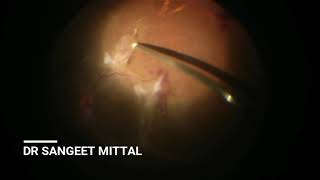 Around the Table Dissection in Proliferative Diabetic Retinopathy with Tractional Retinal Detachment [upl. by Oiliduab]