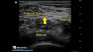 Femoral nerve block  Commenting on technique [upl. by Ariamo]